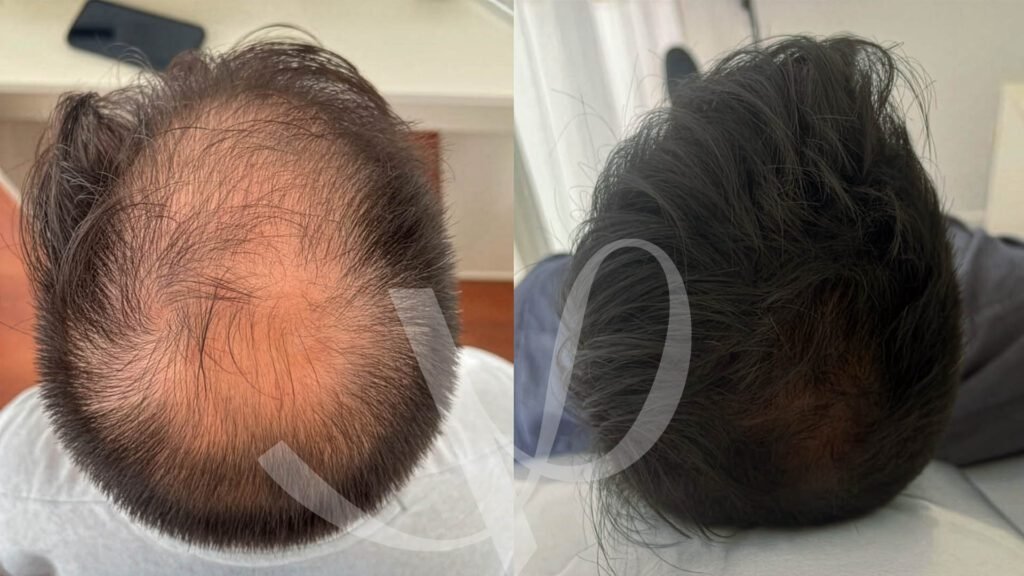 Victoria Medicina Estética - Mesoterapia Capilar