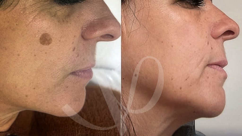 Victoria Medicina Estética - Peeling